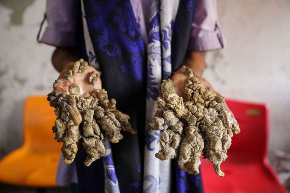 Tree man syndrome, rare